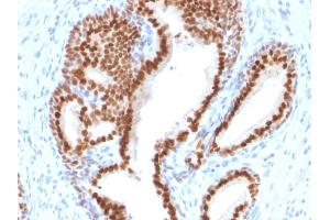 Formalin-fixed, paraffin-embedded human Prostate Carcinoma stained with NKX3. (NKX3-1 抗体  (AA 92-224))