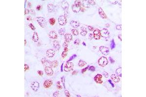 Immunohistochemical analysis of Cyclin G1 staining in human lung cancer formalin fixed paraffin embedded tissue section. (Cyclin G1 抗体  (Center))