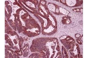 Immunohistochemistry of humen colon cancer with LARS polyclonal antibody . (LARS 抗体)
