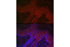 Immunofluorescence analysis of human skin cancer using DKK2 Rabbit pAb (ABIN7266756) at dilution of 1:400 (40x lens). (DKK2 抗体  (C-Term))