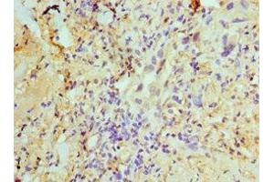 Immunohistochemistry of paraffin-embedded human lung cancer using ABIN7170632 at dilution of 1:100 (U2AF1 抗体  (AA 1-240))