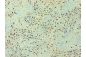 Immunohistochemistry of paraffin-embedded human breast cancer using ABIN7154586 at dilution of 1:100 (DIRAS3 抗体  (AA 1-229))