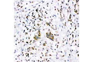 Anti- NR3C1 antibody,IHC(P) IHC(P): Human Mammary Cancer Tissue (Glucocorticoid Receptor 抗体  (AA 1-373))
