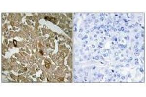 Immunohistochemistry analysis of paraffin-embedded human breast carcinoma tissue, using BTBD6 antibody. (BTBD6 抗体)