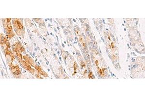 Immunohistochemistry of paraffin-embedded Human gastric cancer tissue using NDUFB7 Polyclonal Antibody at dilution of 1:35(x200) (NDUFB7 抗体)
