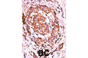 Formalin-fixed and paraffin-embedded human breast cancer tissue reacted with ERBB2 (phospho Y1248) polyclonal antibody  which was peroxidase-conjugated to the secondary antibody followed by AEC staining. (ErbB2/Her2 抗体  (pTyr1248))