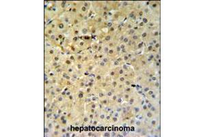 PSME1 Antibody IHC analysis in formalin fixed and paraffin embedded hepatocarcinoma followed by peroxidase conjugation of the secondary antibody and DAB staining. (PSME1 抗体  (C-Term))
