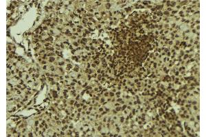 ABIN6278768 at 1/100 staining Human breast cancer tissue by IHC-P. (KAT6B 抗体  (C-Term))
