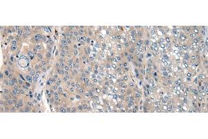 Immunohistochemistry of paraffin-embedded Human liver cancer tissue using CLTCL1 Polyclonal Antibody at dilution of 1:60(x200) (CLTCL1 抗体)