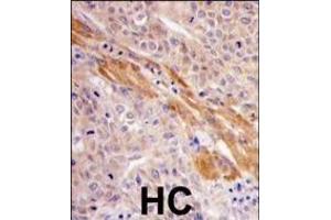 Formalin-fixed and paraffin-embedded human hepatocarcinoma tissue reacted with PGK1 Antibody (Center ) (ABIN391250 and ABIN2837966) , which was peroxidase-conjugated to the secondary antibody, followed by DAB staining. (PGK1 抗体  (AA 305-334))