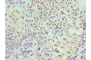 Immunohistochemistry of paraffin-embedded human breast cancer using ABIN7150341 at dilution of 1:100 (MCM7 抗体  (AA 360-719))