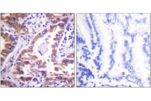 Immunohistochemistry analysis of paraffin-embedded human lung carcinoma tissue, using Calnexin (Ab-583) Antibody. (Calnexin 抗体  (AA 543-592))