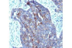 Formalin-fixed, paraffin-embedded human ovarian carcinoma stained with RBP1 (RBP/872) (RBP1 抗体)