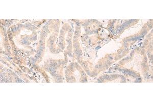 Immunohistochemistry of paraffin-embedded Human thyroid cancer tissue using SEPT10 Polyclonal Antibody at dilution of 1:25(x200) (Septin 10 抗体)