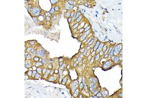 Immunohistochemistry of paraffin-embedded human liver cancer using SLC22/OCT3 Rabbit mAb (ABIN7269107) at dilution of 1:100 (40x lens). (SLC22A3 抗体)