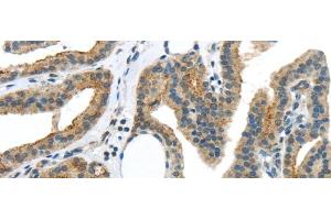 Immunohistochemistry of paraffin-embedded Human thyroid cancer using VAMP2 Polyclonal Antibody at dilution of 1/40 (VAMP2 抗体)