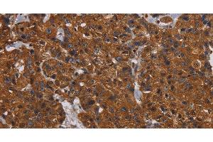 Immunohistochemistry of paraffin-embedded Human breast cancer tissue using HYAL2 Polyclonal Antibody at dilution 1:60 (HYAL2 抗体)