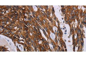 Immunohistochemistry of paraffin-embedded Human colon cancer using KARS Polyclonal Antibody at dilution of 1:60 (KARS 抗体)