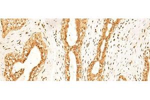 Immunohistochemistry of paraffin-embedded Human breast cancer tissue using ZNF471 Polyclonal Antibody at dilution of 1:50(x200) (ZNF471 抗体)