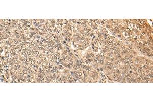 Immunohistochemistry of paraffin-embedded Human liver cancer tissue using BRF2 Polyclonal Antibody at dilution of 1:40(x200) (BRF2 抗体)