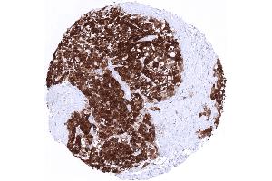 Hepatocellular carcinoma showing strong nuclear and cytoplasmic arginase 1 positivity in all tumor cells (Recombinant Liver Arginase 抗体  (AA 300-400))