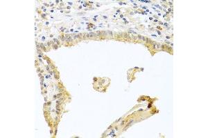 Immunohistochemistry of paraffin-embedded human lung cancer using PRKCA antibody. (PKC alpha 抗体  (C-Term))