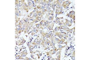 Immunohistochemistry of paraffin-embedded human liver cancer using EIF3L antibody (ABIN6131772, ABIN6140074, ABIN6140075 and ABIN6225315) at dilution of 1:100 (40x lens). (EIF3L 抗体  (AA 1-230))