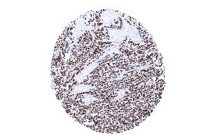 Invasive lobular breast cancer showing strong diffuse CKpan positivity in tumor cells (Recombinant pan Keratin 抗体)