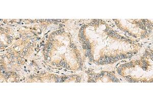 Immunohistochemistry of paraffin-embedded Human lung cancer tissue using NANP Polyclonal Antibody at dilution of 1:65(x200) (NANP 抗体)