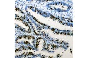 Immunohistochemical analysis of RB1 (pS807) staining in human colon cancer formalin fixed paraffin embedded tissue section.