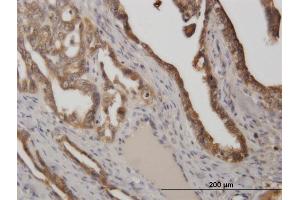Immunoperoxidase of monoclonal antibody to STIP1 on formalin-fixed paraffin-embedded human ovarian cancer. (STIP1 抗体  (AA 1-543))
