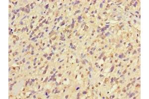 Immunohistochemistry of paraffin-embedded human glioma using ABIN7169120 at dilution of 1:100 (NIM1 抗体  (AA 1-436))