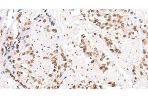 Immunohistochemistry of paraffin-embedded Human prostate cancer using CTBP2 Polyclonal Antibody at dilution of 1:40 (CTBP2 抗体)