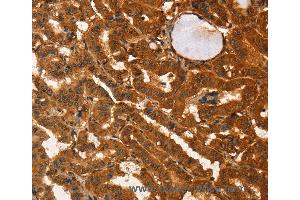 Immunohistochemistry of Human liver cancer using IKZF3 Polyclonal Antibody at dilution of 1:60 (IKZF3 抗体)