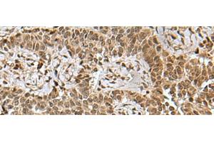 Immunohistochemistry of paraffin-embedded Human ovarian cancer tissue using BCL7B Polyclonal Antibody at dilution of 1:85(x200) (BCL7B 抗体)