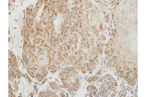 IHC-P Image Immunohistochemical analysis of paraffin-embedded human oral cancer, using PGP9. (UCHL1 抗体  (C-Term))