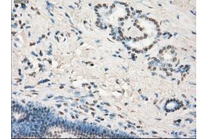 Immunohistochemical staining of paraffin-embedded Adenocarcinoma of colon tissue using anti-LTA4Hmouse monoclonal antibody. (LTA4H 抗体)