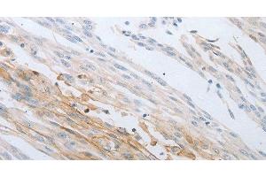 Immunohistochemistry of paraffin-embedded Human cervical cancer using LOX Polyclonal Antibody at dilution of 1:30 (LOX 抗体)