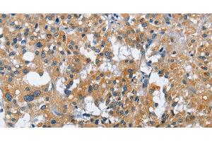 Immunohistochemistry of paraffin-embedded Human thyroid cancer tissue using CREB2 Polyclonal Antibody at dilution 1:40 (ATF4 抗体)