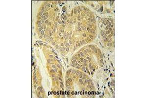 ENAM antibody immunohistochemistry analysis in formalin fixed and paraffin embedded human prostate carcinoma followed by peroxidase conjugation of the secondary antibody and DAB staining. (Enamelin 抗体  (C-Term))