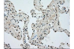 Immunohistochemical staining of paraffin-embedded Adenocarcinoma of breast tissue using anti-NAT8 mouse monoclonal antibody. (NAT8 抗体)