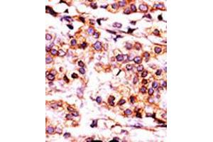 Formalin-fixed and paraffin-embedded human cancer tissue reacted with the primary antibody, which was peroxidase-conjugated to the secondary antibody, followed by AEC staining. (PANK1 抗体  (AA 332-360))