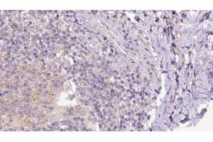 ABIN6273162 at 1/100 staining Human lymph cancer tissue by IHC-P. (SH2D1B 抗体  (Internal Region))