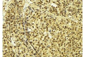 ABIN6277602 at 1/100 staining Human breast cancer tissue by IHC-P. (OTX2 抗体  (Internal Region))