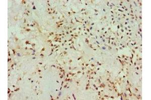 Immunohistochemistry of paraffin-embedded human breast cancer using ABIN7142904 at dilution of 1:100 (AKAP13 抗体  (AA 1-150))