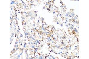 Immunohistochemistry of paraffin-embedded Human lung cancer using Fibronectin Polyclonal Antibody at dilution of 1:100 (40x lens). (Fibronectin 抗体)