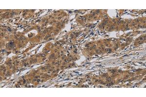 Immunohistochemistry of paraffin-embedded Human gasrtic cancer tissue using INPPL1 Polyclonal Antibody at dilution 1:40 (INPPL1 抗体)