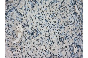 Immunohistochemical staining of paraffin-embedded Adenocarcinoma of breast tissue using anti-NEK6 mouse monoclonal antibody. (NEK6 抗体)