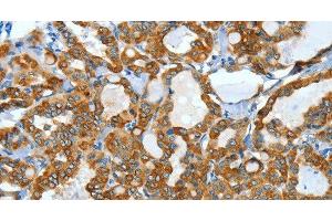 Immunohistochemistry of paraffin-embedded Human thyroid cancer using KRT40 Polyclonal Antibody at dilution of 1:50 (KRT40 抗体)