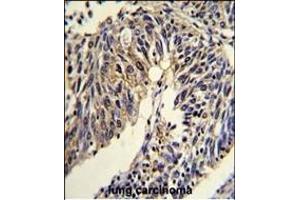 Formalin-fixed and paraffin-embedded human lung carcinoma reacted with TNFRSF14 Antibody (Center), which was peroxidase-conjugated to the secondary antibody, followed by DAB staining. (HVEM 抗体  (AA 210-236))